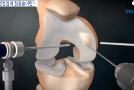 무릎 골관절염 절골술은 어떻게 할까?